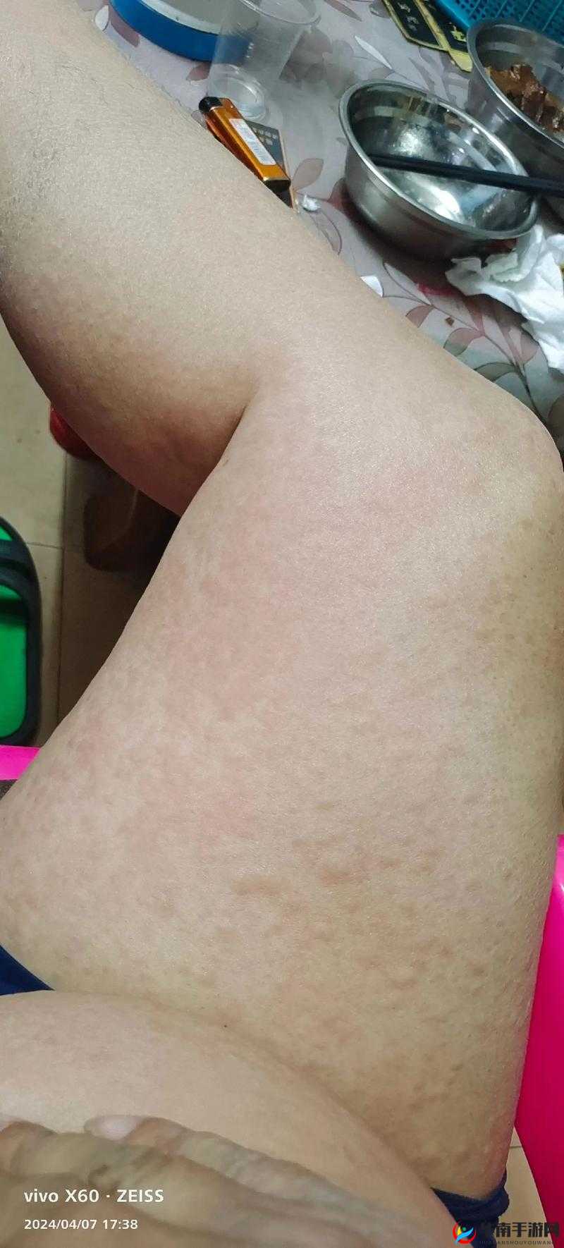 淑芬两腿中间瘙痒难耐引发的一系列状况